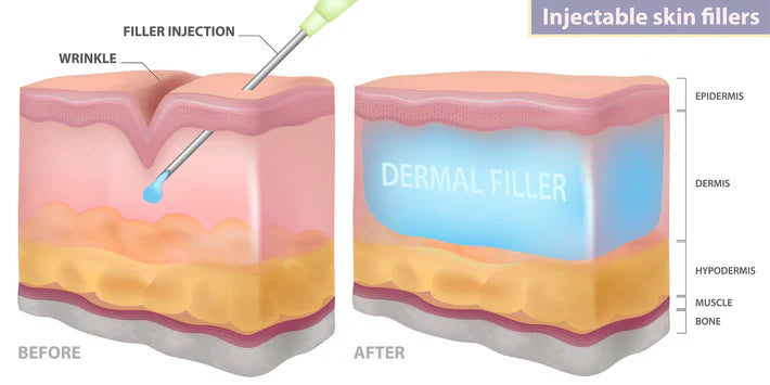 Dermal Fillers on Cheeks and Chin: What You Need to Know!