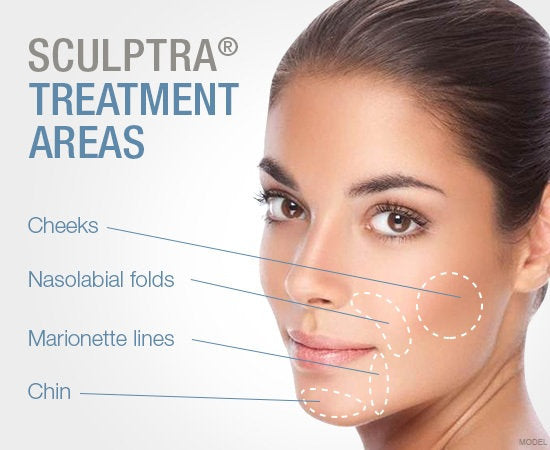 Sculptra® Smile Line Reduction