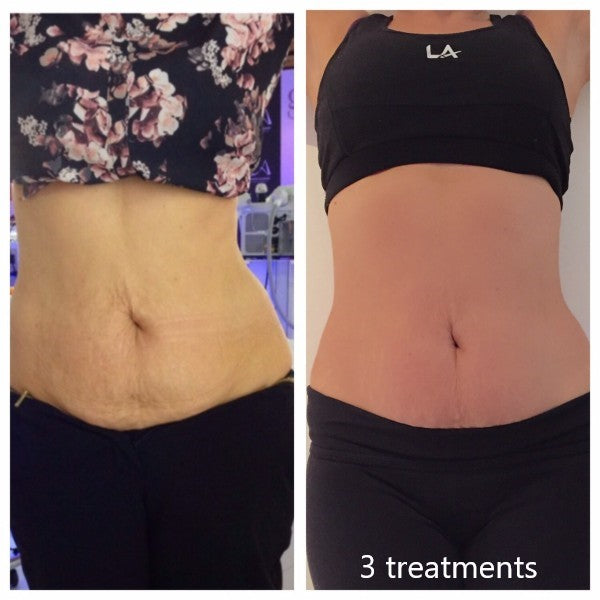 Hands Body Contouring – Pack of 6 Sessions
