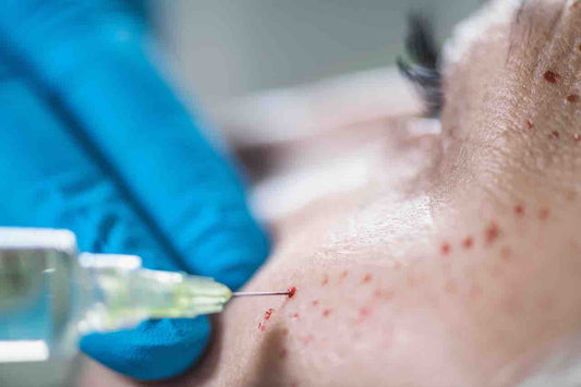PRP “Vampire” Facial – Face