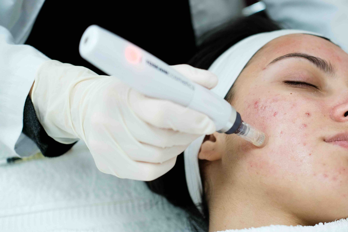 PRP “Vampire” Facial – Face & Neck (Pack of 3 Sessions)
