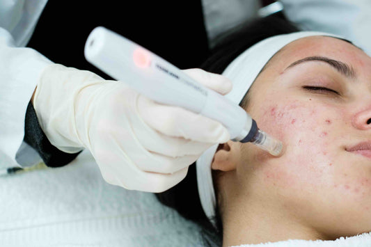 PRP “Vampire” Facial – Face & Neck (Pack of 3 Sessions)