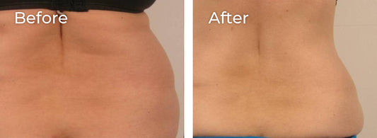 Love Handles Body Contouring