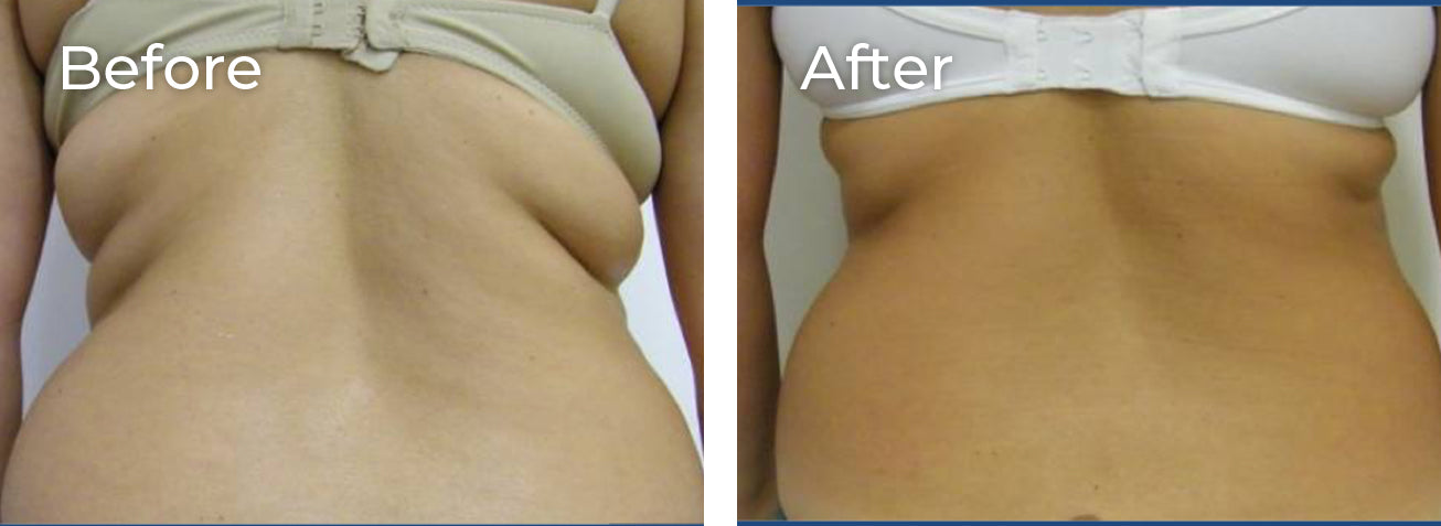 Hands Body Contouring – Pack of 6 Sessions