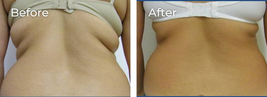 Bra Back Body Contouring – Pack of 6 Sessions