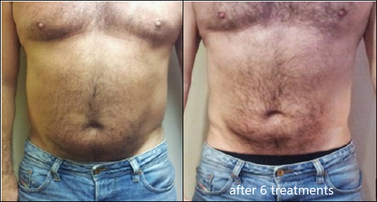 Love Handles & Abdomen Body Contouring