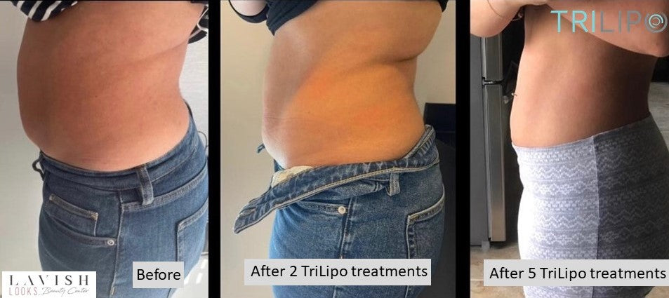 Hands Body Contouring – Pack of 6 Sessions