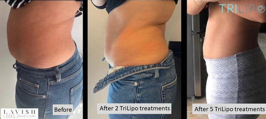 Hands Body Contouring – Pack of 6 Sessions