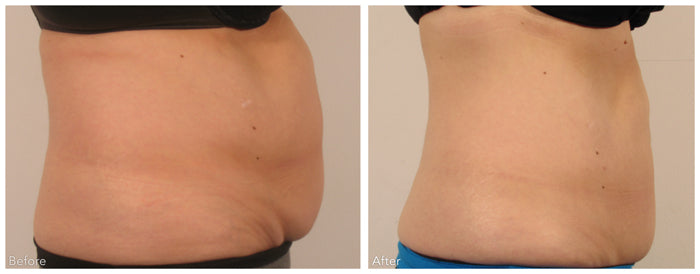 Hands Body Contouring – Pack of 6 Sessions