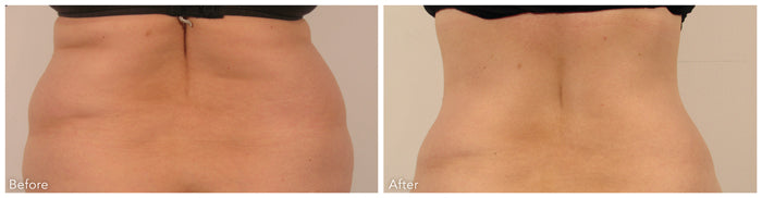Hands Body Contouring – Pack of 6 Sessions
