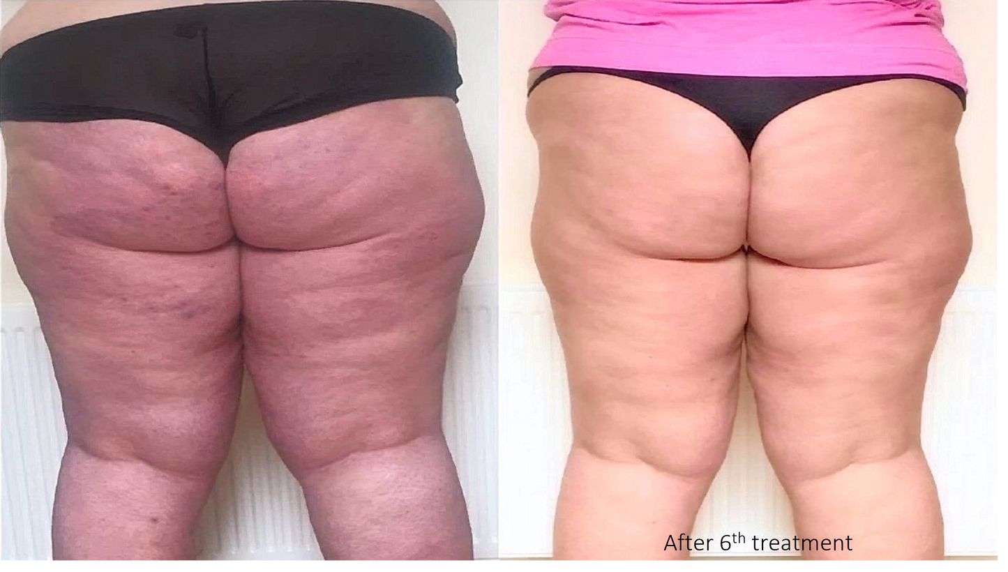 Hands Body Contouring – Pack of 6 Sessions