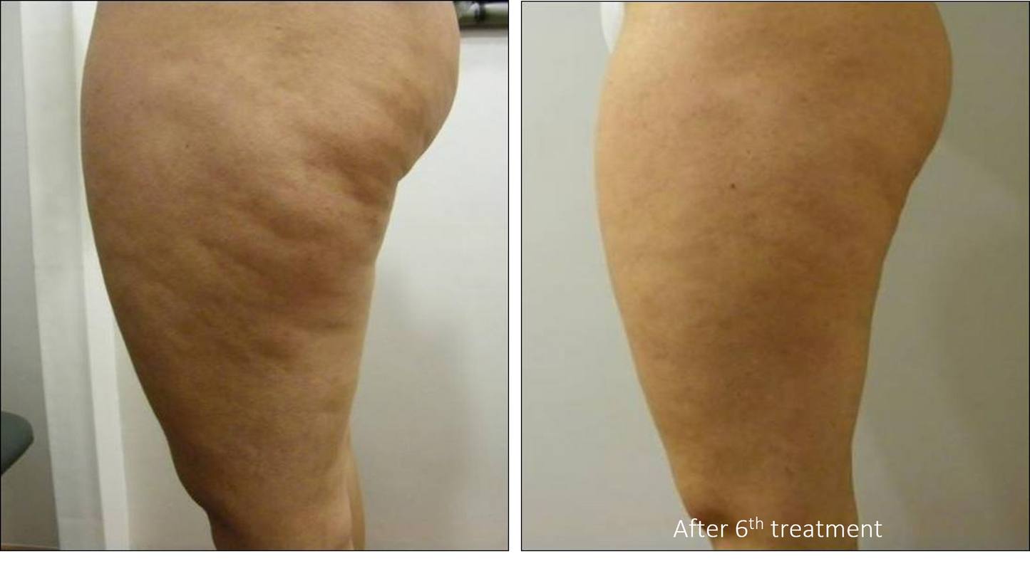 Hands Body Contouring – Pack of 6 Sessions