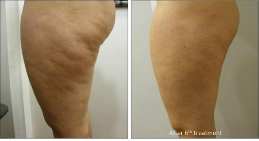 Thighs Body Contouring