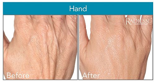 Radiesse® Hand Rejuvenation