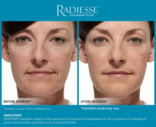 Radiesse® for Nasolabial Folds & Marionette Lines