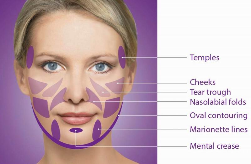 Sculptra® Chin Enhancement