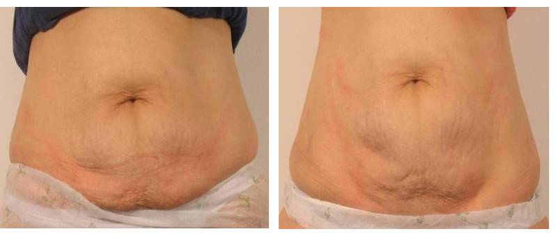 Hands Body Contouring – Pack of 6 Sessions