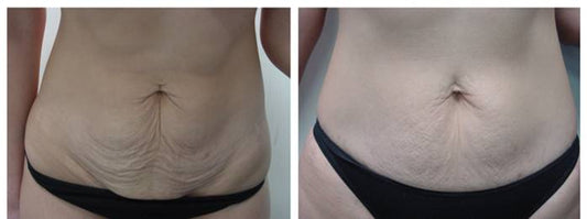 Full Face & Neck Body Contouring