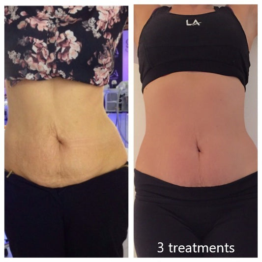 Neck Body Contouring