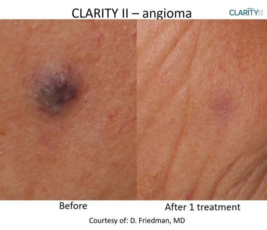 Laser Skin Tag/ Mole & Wart Removal