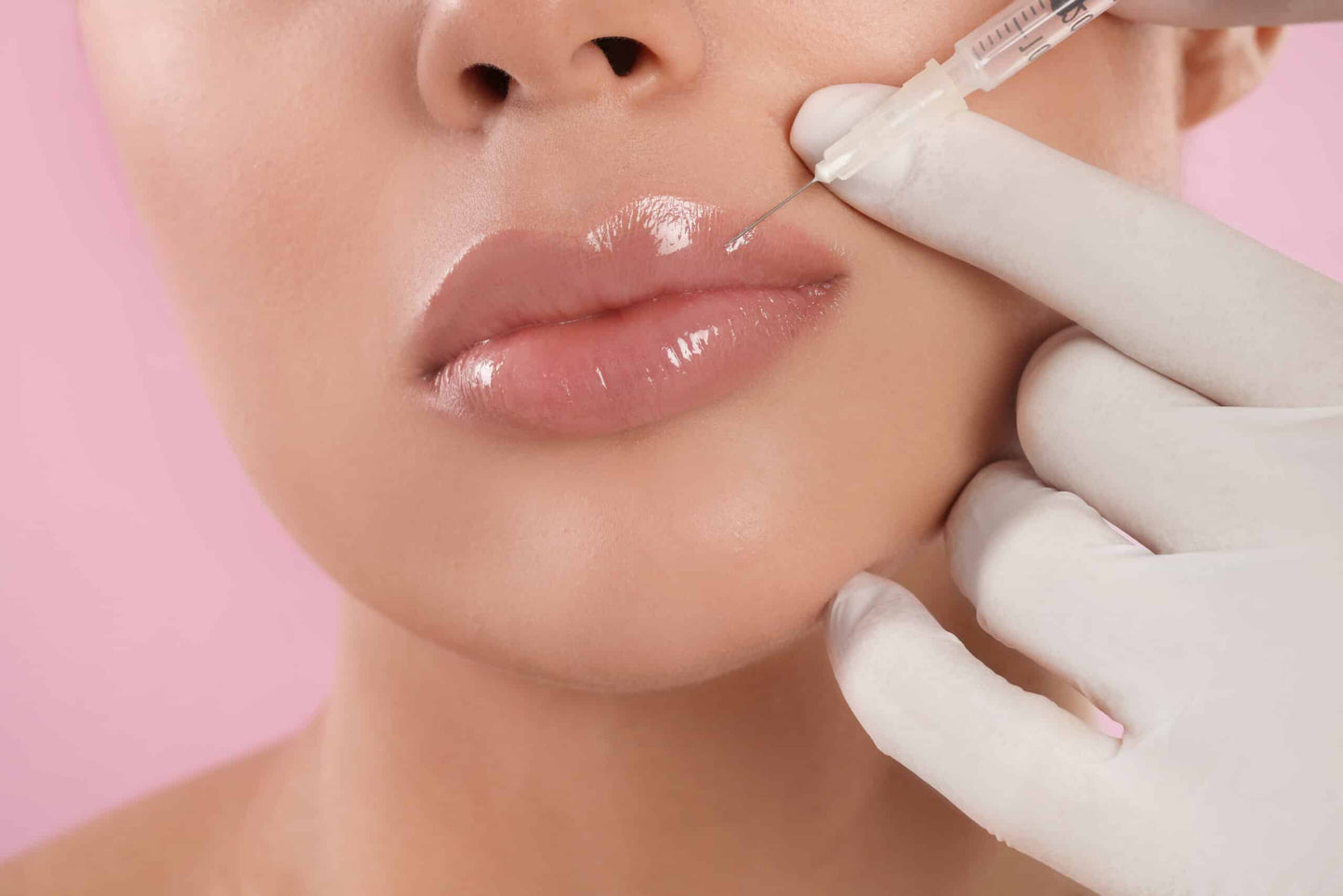 Lip Dermal Fillers