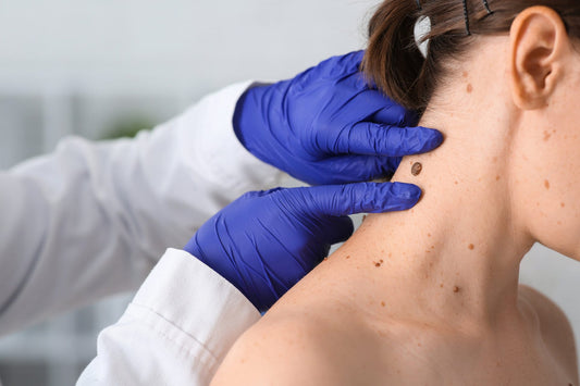 Mole and Tag Removal (Pack of 10 spots any size)