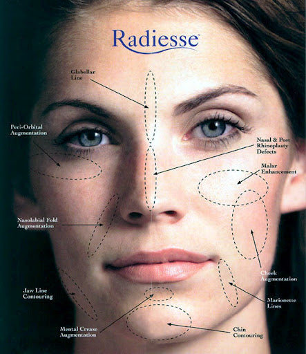 Radiesse® Collagen-Stimulating Rejuvenation & Contouring – Package of 3