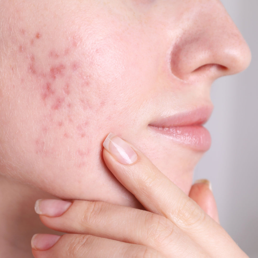 Clarity II Acne Laser Facial