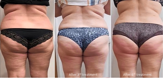 Butt lift (Body Contouring)