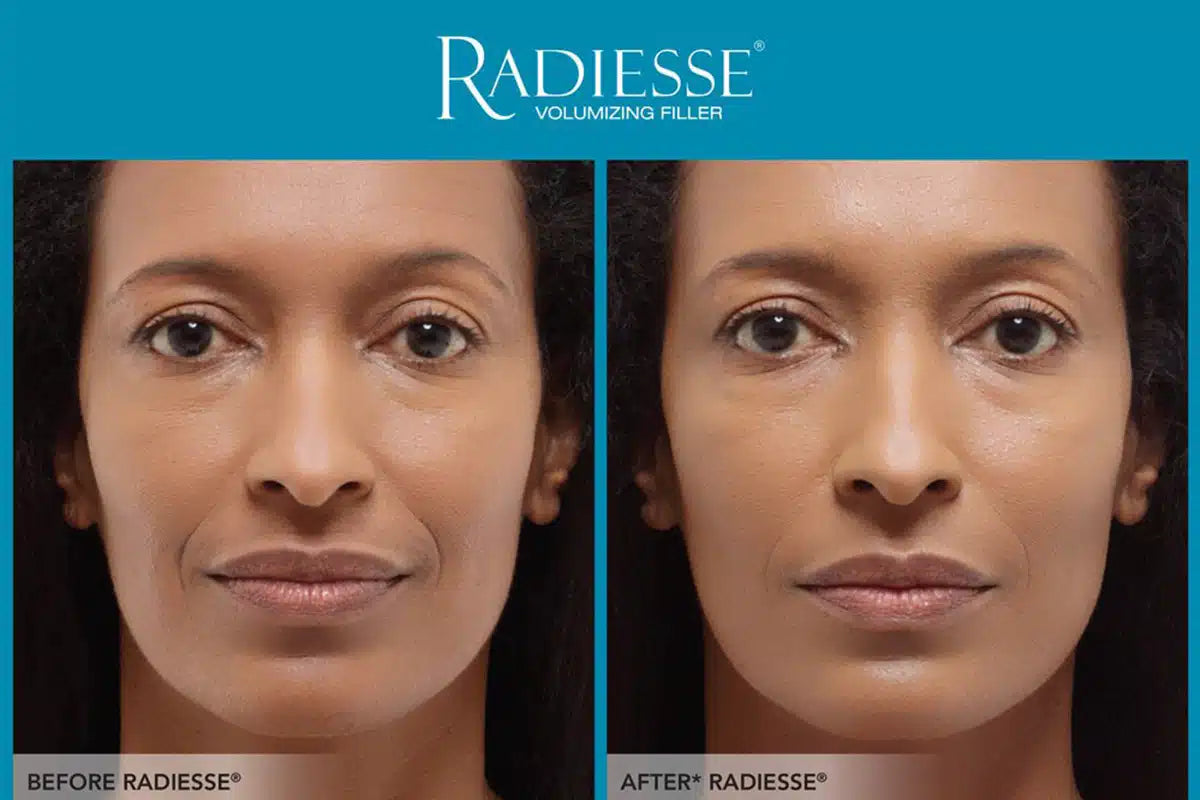 Radiesse® Collagen-Stimulating Rejuvenation & Contouring – Package of 3